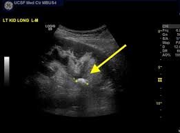 Ultrasound Guided Pcnl Innovation Comes With Patient Safety And Treatment Efficacy Not Radiation Exposure The Chi Laboratory