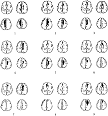 Involuntary Movements After Anterior Cerebral Artery Territory Infarction Stroke As mentioned earlier, the abnormal patterns of motor unit recruitment can be explained by the failure of central voluntary activation 28, 29. involuntary movements after anterior
