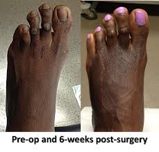 Unfortunately, accidents, age or genes can lead to a loss of full or partial vision, leaving us with a foggy or blurred vie. Cosmetic Foot Surgery Home Facebook