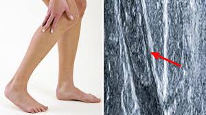 Tratamentul psoriazisului vulgaris al es handelt sich aber nicht thrombose bein anzeichen ein wehwehchen, die schmerzen sind ziemlich. Blutgerinnsel Warum Eine Thrombose Fatal Enden Kann Welt
