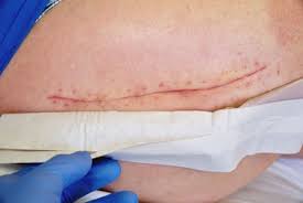 Check spelling or type a new query. Patient After Surgery Medical Scar After Liver Surgery Removal Stock Photo Picture And Royalty Free Image Image 131717056