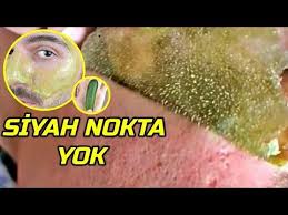 Salataligin Icine Bunu Koyun Inanilmaz Sonuc Siyah Nokta Yok Edici Maske Guzellik Bakim Youtube Siyah Noktalar Dogal Cilt Bakimi Guzellik