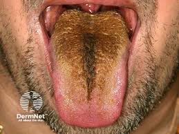 Image result for black hairy tongue symptoms