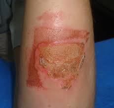 Image result for dermatitis contacta
