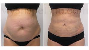 Upper And Lower Abdomen Pannus Love Handles And Hips Smartlipo On All 2 Weeks Smart Lipo Lipo Lipo Before And After