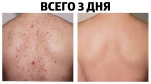 как избавиться от прыщей на теле в домашних условиях Kak Izbavitsya Ot Pryshej Na Spine Za 3 Dnya V Domashnih Usloviyah Youtube