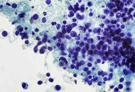 For people with small cell lung cancer, the overall survival rate is 6%. Is Adenocarcinoma Of The Lung An Aggressive Cancer