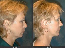 World-Class Facial Plastic Surgeon Richmond