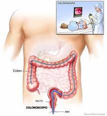 A colonoscopy is first done to detect the presence of any polyps. No Need To Be Fearful Of A Colonoscopy Caribbean News