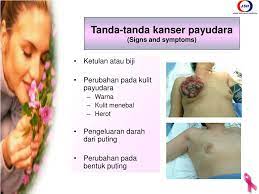 Gejala kanser atau tanda barah otak dipengaruhi oleh bahagian otak terlibat dan sistem yang berfungsi mempengaruhinya. Ppt Kanser Payu Dara Breast Cancer Powerpoint Presentation Free Download Id 4921647