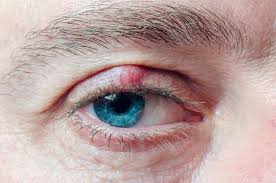 Wie wird ein hagelkorn behandelt? Gerstenkorn Hordeolum Und Hagelkorn Chalazion Augenarzt Dr Robert Borny