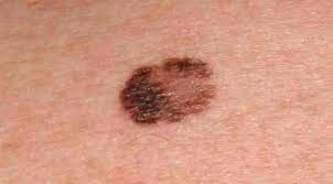 Can melanoma skin cancer be found early? Skin Cancer Melanoma Detector Devpost