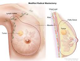 Kudal cancer symptoms in tamil,breast cancer symptoms in tamil language,mouth cancer symptoms in tamil,throat cancer symptoms in tamil language. Definition Of Modified Radical Mastectomy Nci Dictionary Of Cancer Terms National Cancer Institute