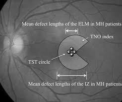 Our range includes charts, trial lenses and frames, vision tests, chairs and stands, diagnostic instruments and consumables. Stereopsis And Retinal Microstructures Following Macular Hole Surgery Scientific Reports