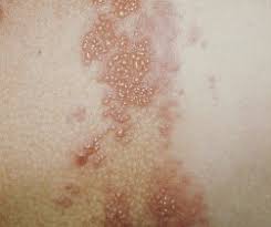 It can also be spread through contact with lesions from other areas of the body. Genital Herpes Hsv 1 2 Symptoms And Treatments