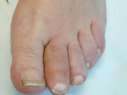 Image result for Dactylitis