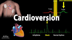 Image result for Synchronized Cardioversion