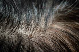 View head lice pictures and photos of nits so that you can identify live lice on your child's hair and know when to treat your kids or yourself. 416 Hair Lice Louse Photos Free Royalty Free Stock Photos From Dreamstime