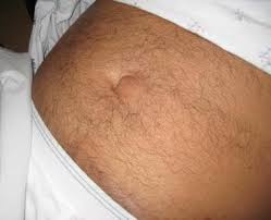 Image result for Hernia Reduction