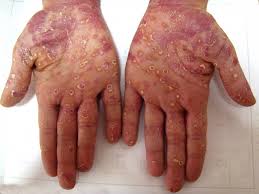 Image result for Secondary Syphilis