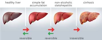 We did not find results for: Ficatul Gras Steatoza Hepatica Diabet Nutritie Si Boli Metabolice