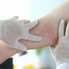 Image result for dermatitis contacta toxica