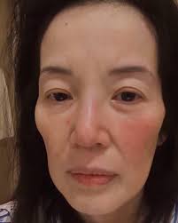Kris Aquino: "This is MY NOW… i wanted you to see the pain and struggle so  that you will continue to pray. i have a Lupus Flare fever now. It's been  more