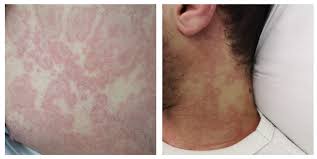 Image result for Multisystem Inflammatory Syndrome