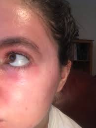 Skin Concern What Can I Use Besides Aquaphor To Get Rid Of Help Soothe These Dry Red Patchy Places That Are Appearing Under My Eyes When I Wake Up In The Morning