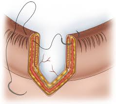 Its disadvantage is a relatively high pr. Internal Vertical Mattress Eyelid Reconstruction Springerlink