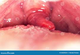 Image result for Uvulitis