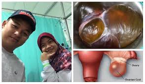 Secara biologis, kentang termasuk dalam golongan tumbuhan yang memiliki umbi, lebih tepatnya umbi batang. Ada Sesuatu Di Kilang Telur Saya Disangka Hamil Rupa Rupanya Ada Cyst Kantung Sebesar 30cm