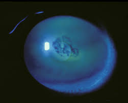 The corneal epithelial basement membrane: Treatment Of Epithelial Basement Membrane Dystrophy With Manual Superficial Keratectomy Eyerounds Org Ophthalmology The University Of Iowa