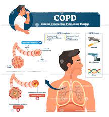 Chronic obstructive pulmonary disease diagnosis and. Copd Disease Anatomical Vector Illustration Infographic Diagram Chronic Obstructive Pulmonary Disease Copd Pulmonary Disease