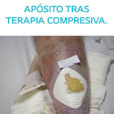 Manejo Del Exudado En Las Ulceras Venosas Menos Dias Con Heridas