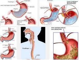 Image result for Reflux Laryngitis