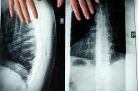 Image result for Abdominal XRay