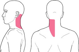 The pain comes and goes. answered by dr. 4 Typical Pain Distribution Relating To Extracranial Vertebral Artery Download Scientific Diagram