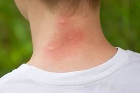 They look like flea bites but they're not. Are You Allergic To Mosquito Bites Terminix