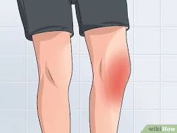 Tubuh manusia tersusun atas berbagai macam organ dan juga jaringan sel yang. 4 Cara Untuk Mengobati Tendinitis Patela Wikihow