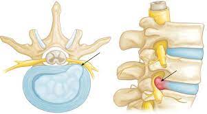 Performed when there is evidence of spinal instability or. Cervical Spondylotic Myelopathy Csm Spinal Cord Compression Orthoinfo Aaos