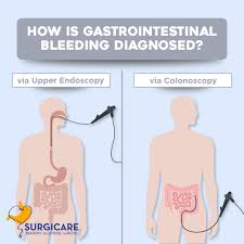 Image result for Colonoscopy in GI Bleeding