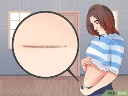 For men, it is called a vasectomy. How To Get Tied Tubes Untied 15 Steps With Pictures Wikihow