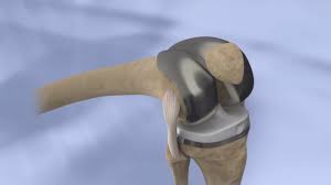 Total Knee Replacement A Patient S Guide Uw Orthopaedics And Sports Medicine Seattle