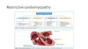 Image result for Restrictive Cardiomyopathy