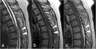 Image result for Spinal Epidural Abscess
