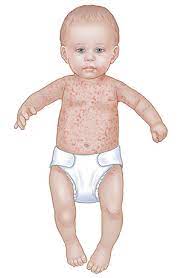 Symptoms of roseola in baby. When Your Child Has Roseola Saint Luke S Health System