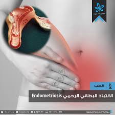 About stages signs causes risk factors. Ø§Ù„Ø¨Ø§Ø­Ø«ÙˆÙ† Ø§Ù„Ø³ÙˆØ±ÙŠÙˆÙ† Ø§Ù„Ø§Ù†ØªØ¨Ø§Ø° Ø§Ù„Ø¨Ø·Ø§Ù†ÙŠ Ø§Ù„Ø±Ø­Ù…ÙŠ Endometriosis