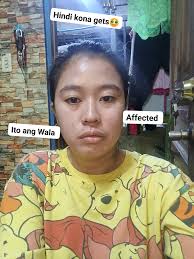 Mag6months na Hindi pantay🥹🥹🥹 Bakit kaya naigalaw ko nMn Bakit ang  kabila Lang namn affected Peru ang kabila ngiba Baka mymaka suggest Jan  saakin 🥹