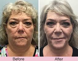 Facelift Before and After Photos Riverside CA